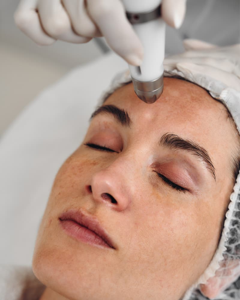 Pigmentlaser