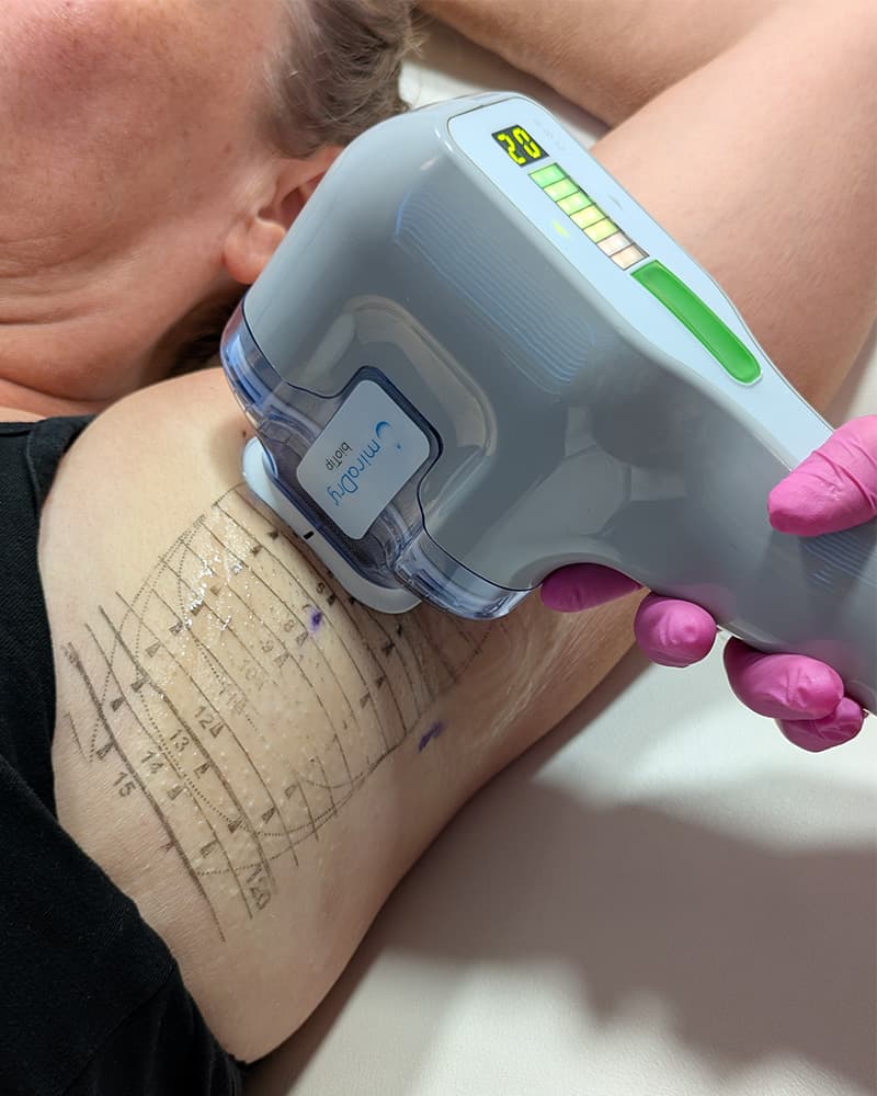 miraDry behandeling bij Cosmedics