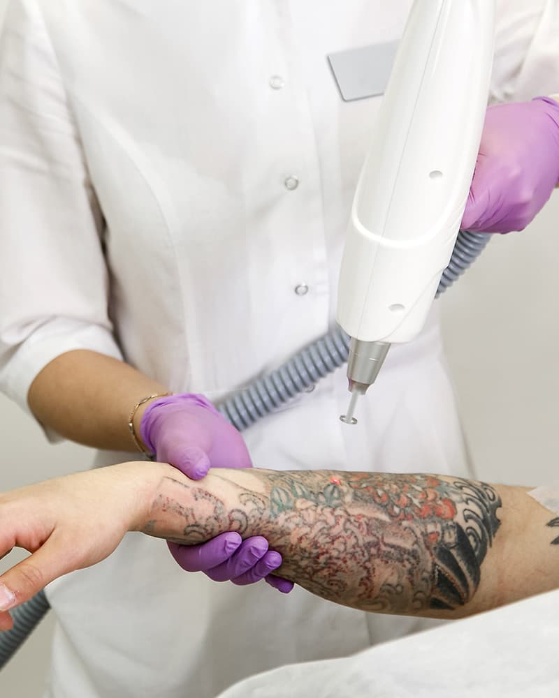 Tattoo Verwijdering